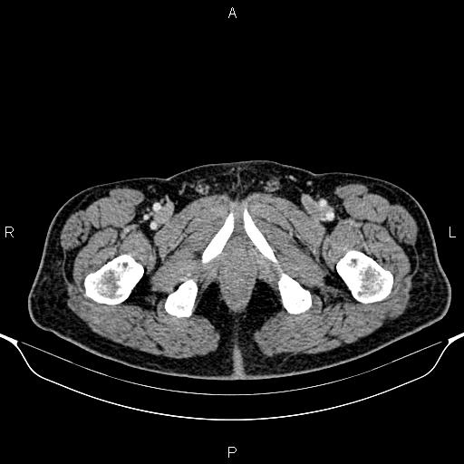 Cecal adenocarcinoma (Radiopaedia 85324-100916 B 106).jpg