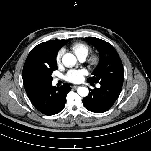 File:Cecal cancer with appendiceal mucocele (Radiopaedia 91080-108651 A 35).jpg