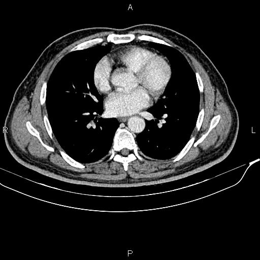 File:Cecal cancer with appendiceal mucocele (Radiopaedia 91080-108651 B 1).jpg