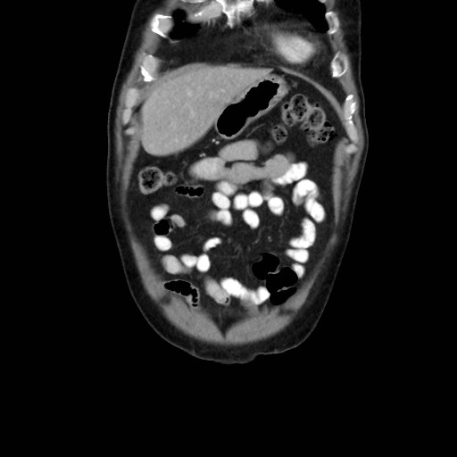 File:Cecal mass causing appendicitis (Radiopaedia 59207-66531 B 9).jpg