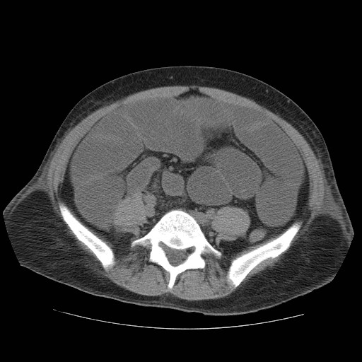 Cecal volvulus (Radiopaedia 28294-28534 Axial non-contrast 68).jpg