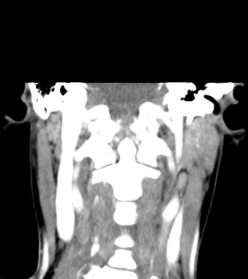 Cemento-ossifying fibroma (Radiopaedia 46243-50643 Coronal C+ delayed 42).png