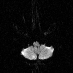 File:Central-variant posterior reversible encephalopathy syndrome (PRES) (Radiopaedia 43880-47358 Axial DWI 3).jpg