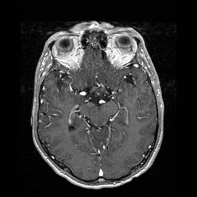 File:Central-variant posterior reversible encephalopathy syndrome (PRES) (Radiopaedia 43880-47358 Axial T1 C+ 65).jpg