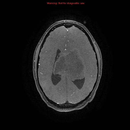 Central neurocytoma (Radiopaedia 13188-13206 Axial MRA 6).jpg