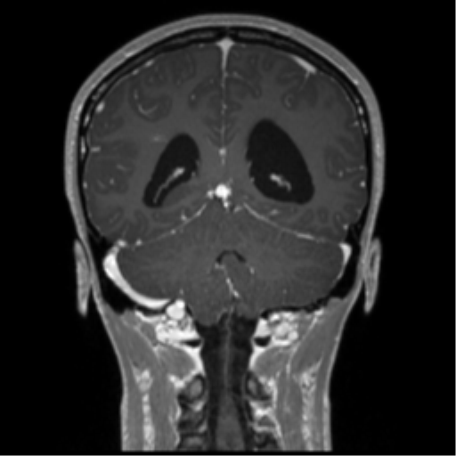 Central neurocytoma (Radiopaedia 37664-39557 Coronal T1 C+ 29).png