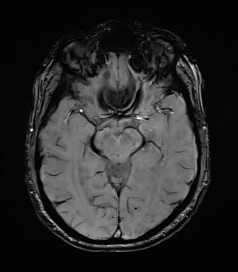 File:Central neurocytoma (Radiopaedia 71068-81303 Axial SWI 25).jpg