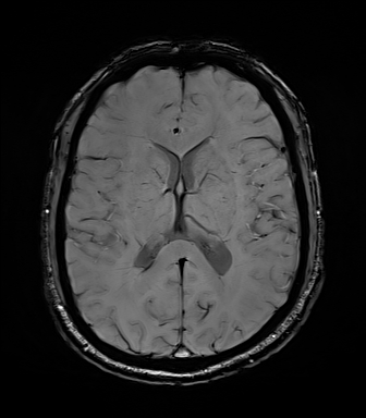 Central neurocytoma (Radiopaedia 71068-81303 Axial SWI 36).jpg