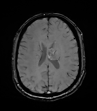 File:Central neurocytoma (Radiopaedia 71068-81303 Axial SWI 41).jpg