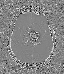 Central neurocytoma (Radiopaedia 84497-99872 Axial 40).jpg