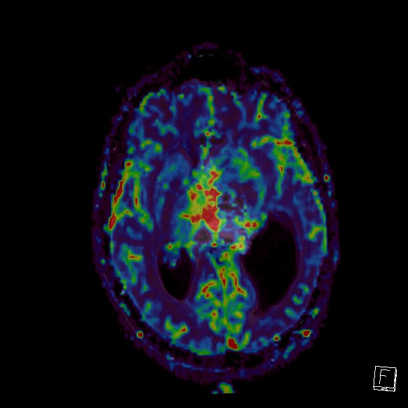 Central neurocytoma (Radiopaedia 84497-99872 Axial Perfusion 163).jpg