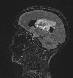 File:Central neurocytoma (Radiopaedia 84497-99872 Sagittal Flair + Gd 64).jpg