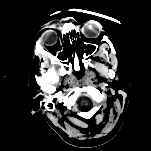 Cerebellar abscess (Radiopaedia 78135-90671 Axial non-contrast 7).jpg