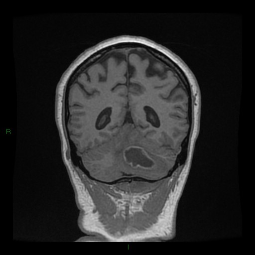 Cerebellar abscess (Radiopaedia 78135-90678 Coronal T1 C+ 120).jpg
