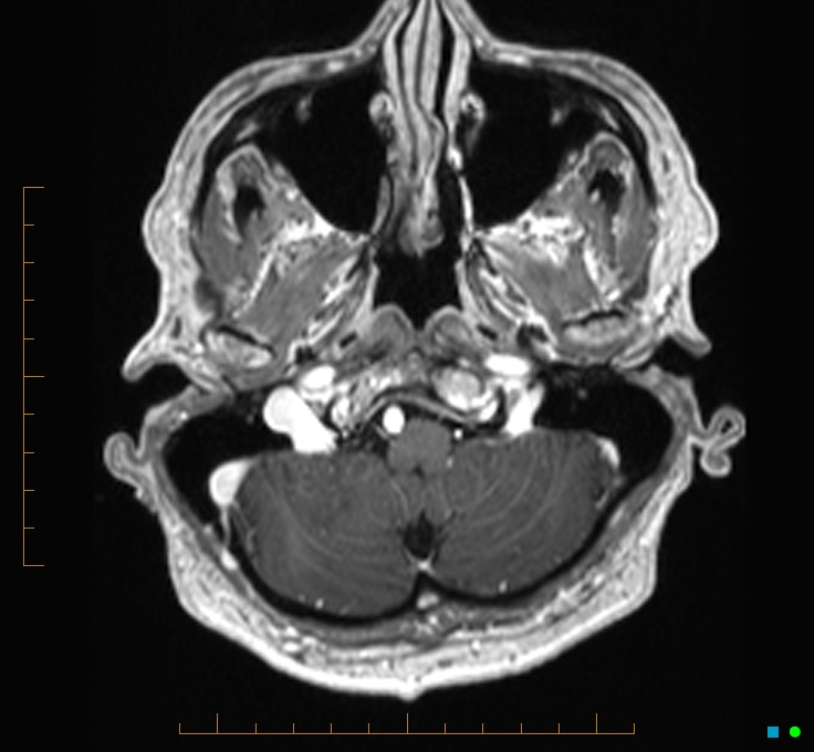 Cerebellar gangliocytoma (Radiopaedia 65377-74422 Axial T1 C+ 10).jpg
