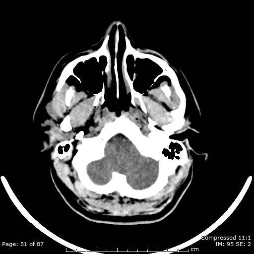 Cerebellar hemangioblastoma (Radiopaedia 52360-58258 Axial non-contrast 81).jpg
