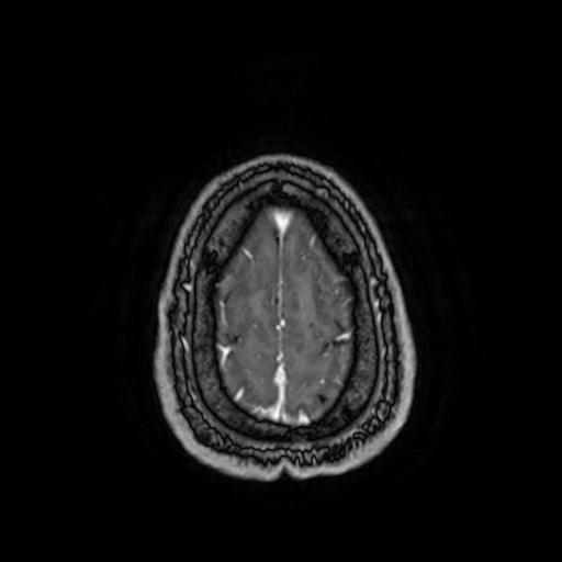 Cerebellar hemangioblastoma (Radiopaedia 88055-104622 Axial T1 C+ 156).jpg