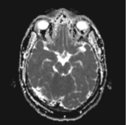 File:Cerebellar hemangioblastomas and pituitary adenoma (Radiopaedia 85490-101176 Axial ADC 13).png