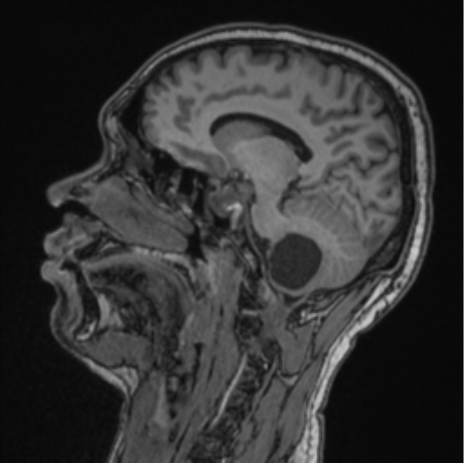 Cerebellar hemangioblastomas and pituitary adenoma (Radiopaedia 85490-101176 Sagittal T1 58).png