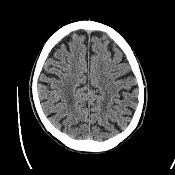Cerebellar hemorrhage (Radiopaedia 27193-27359 Axial non-contrast 39).jpg