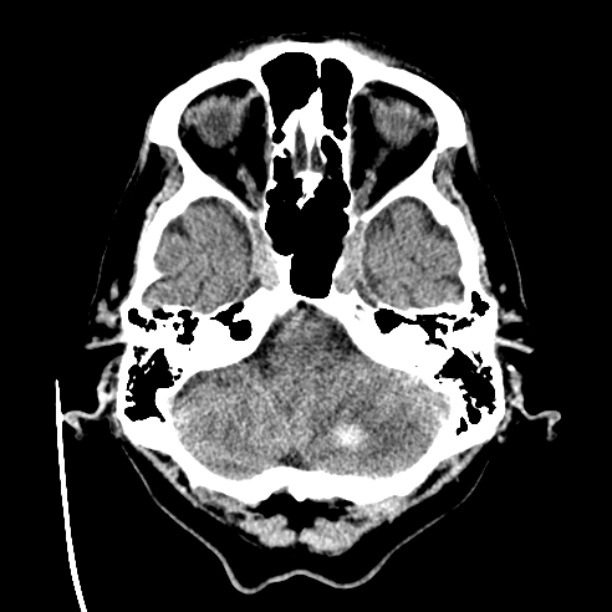 Cerebellar hemorrhage (Radiopaedia 27193-27359 Axial non-contrast 8).jpg