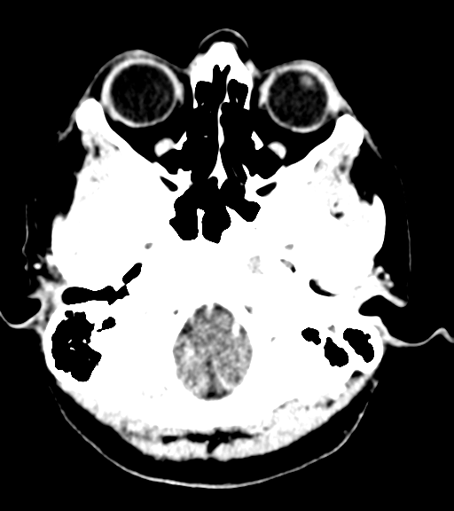 Cerebellar metastases - colorectal adenocarcinoma (Radiopaedia 40947-43652 Axial C+ 5).png
