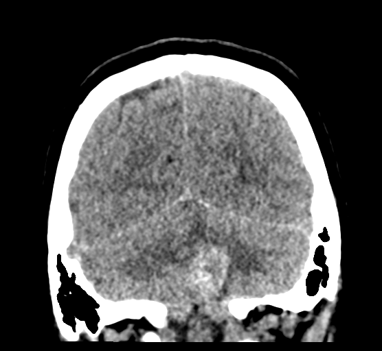 File:Cerebellar metastases - colorectal adenocarcinoma (Radiopaedia 40947-43652 Coronal non-contrast 74).png