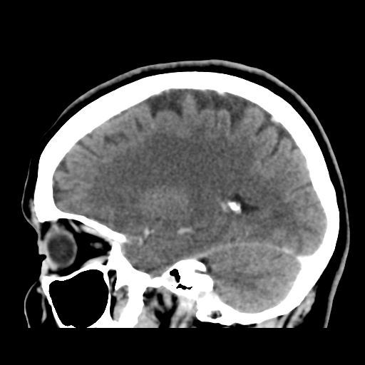 File:Cerebellar metastasis (cystic appearance) (Radiopaedia 41395-44258 F 35).png