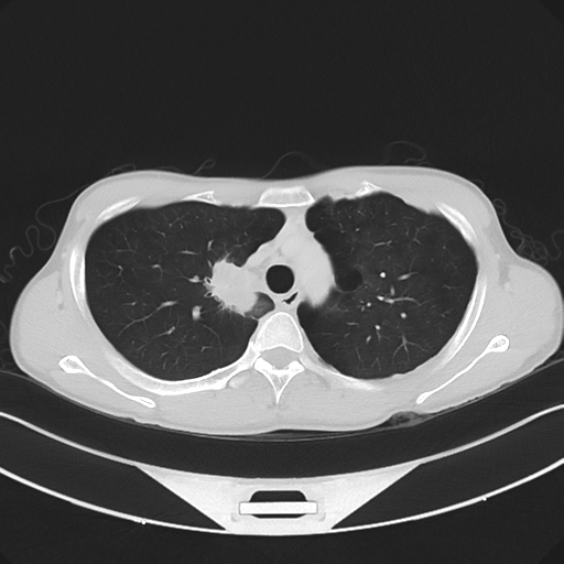 Cerebellar metastasis - adenocarcinoma lung (Radiopaedia 63184-71717 Axial lung window 21).png