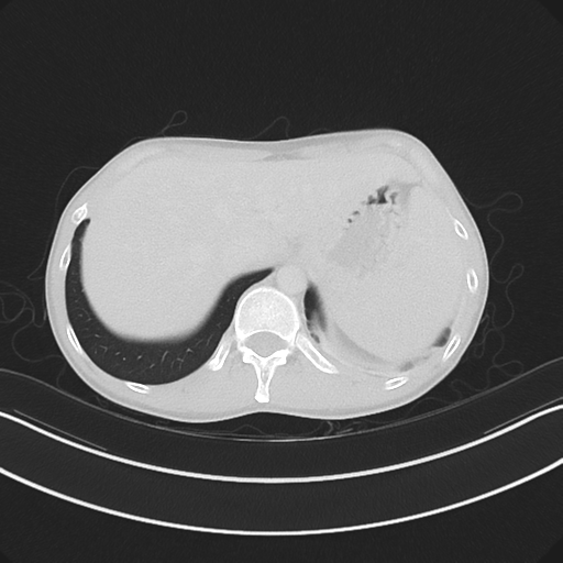 Cerebellar metastasis - adenocarcinoma lung (Radiopaedia 63184-71717 Axial lung window 63).png