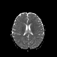 File:Cerebellar stroke (Radiopaedia 32202-33150 Axial ADC 15).png