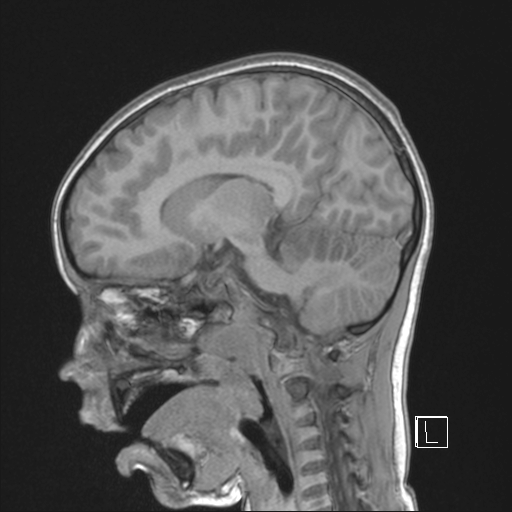 Cerebellar stroke (Radiopaedia 32202-33150 Sagittal T1 C+ 22).png