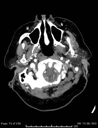 Cerebellar strokes due to intracranial giant cell arteritis (Radiopaedia 68799-78510 CT angiogram 73).jpg