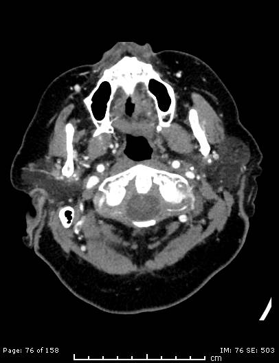 Cerebellar strokes due to intracranial giant cell arteritis (Radiopaedia 68799-78510 CT angiogram 76).jpg