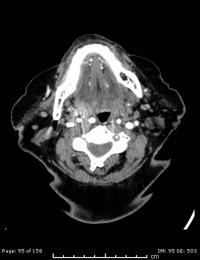 File:Cerebellar strokes due to intracranial giant cell arteritis (Radiopaedia 68799-78510 CT angiogram 95).jpg