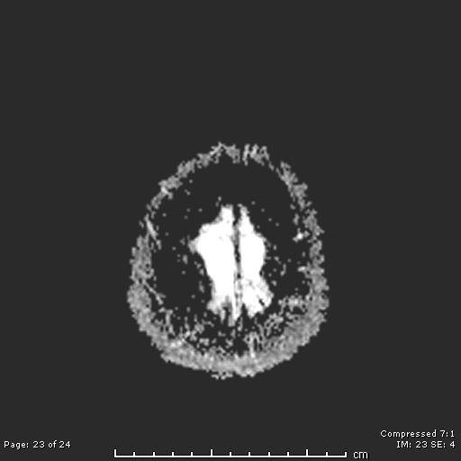 File:Cerebellar strokes due to intracranial giant cell arteritis (Radiopaedia 68799-81713 Axial ADC 23).jpg
