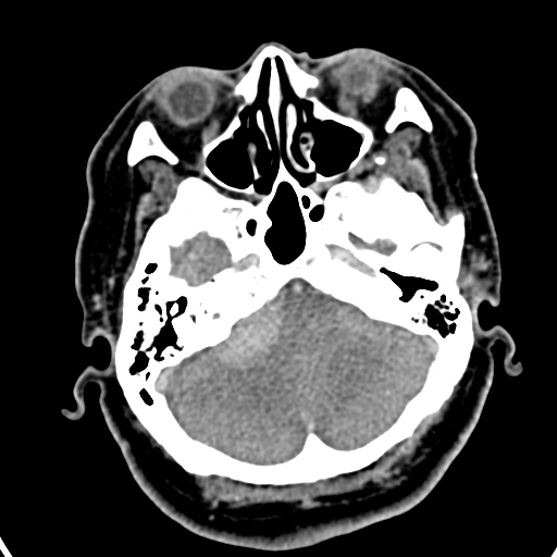 Cerebellopontine angle meningioma (Radiopaedia 35181-36714 A 34).jpg