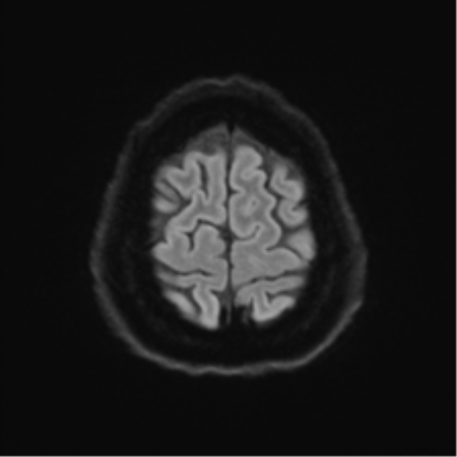 Cerebellopontine angle meningioma (Radiopaedia 48434-53348 Axial DWI 71).png