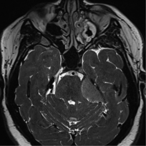Cerebellopontine angle meningioma (Radiopaedia 48434-53348 Axial T2 Space 72).png