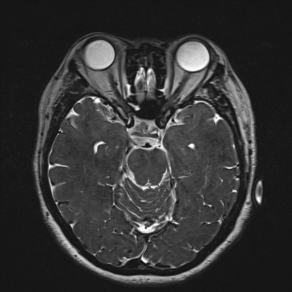 Cerebellopontine angle meningioma (Radiopaedia 53561-59591 Axial 3D volume T2 91).jpg