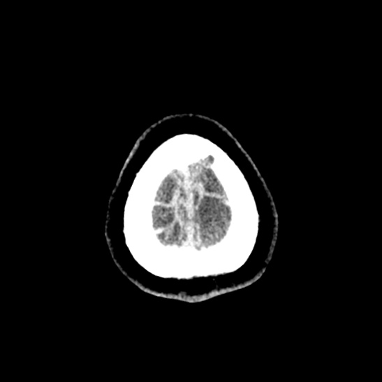 Cerebellopontine angle meningioma (Radiopaedia 53561-59592 Axial non-contrast 67).jpg