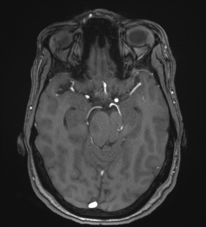 Cerebellopontine angle meningioma (Radiopaedia 72983-83680 Axial MRA 48).jpg