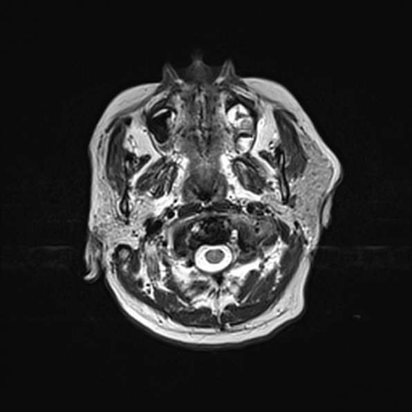Cerebral abscess (Radiopaedia 26111-26247 Axial T2 7).jpg