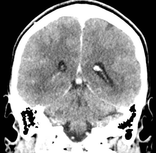 Cerebral abscess (Radiopaedia 60342-68008 Coronal C+ delayed 43).png
