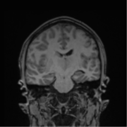 Cerebral abscess (Radiopaedia 60342-68009 Coronal T1 23).png