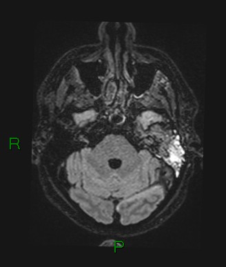 Cerebral abscess and subdural empyema (Radiopaedia 84436-99779 Axial FLAIR 63).jpg