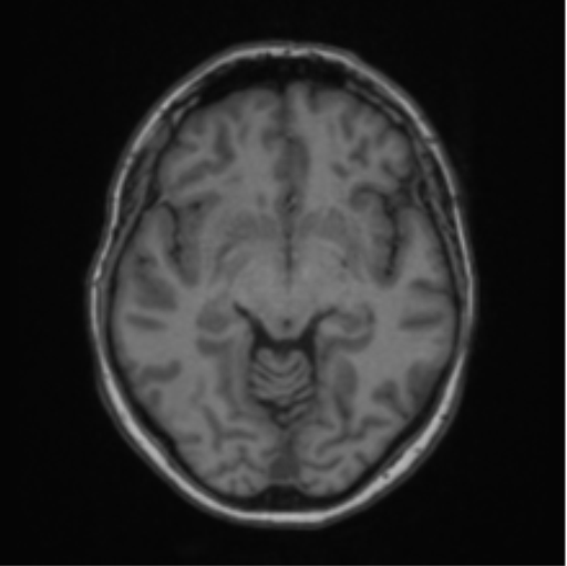 Cerebral abscess from pulmonary arteriovenous malformation (Radiopaedia 86275-102291 Axial T1 34).png