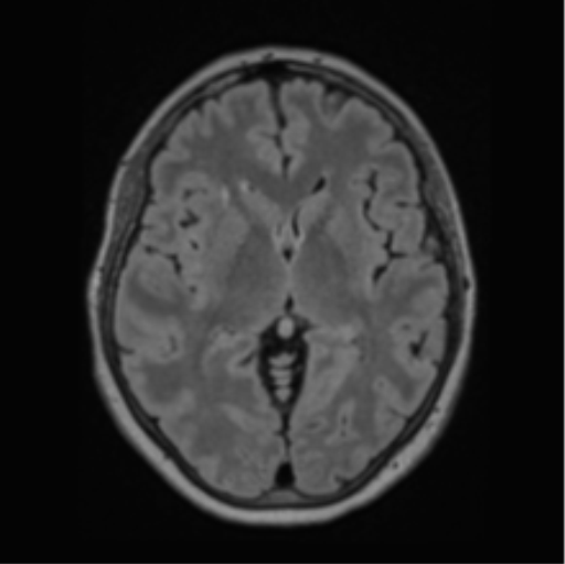 Cerebral abscess from pulmonary arteriovenous malformation (Radiopaedia 86275-102291 J 38).png
