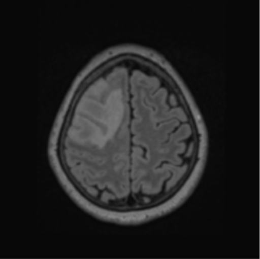 File:Cerebral abscess from pulmonary arteriovenous malformation (Radiopaedia 86275-102291 J 60).png
