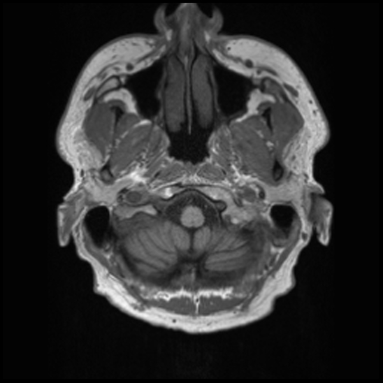File:Cerebral abscess with ventriculitis (Radiopaedia 78965-91878 Axial T1 4).jpg